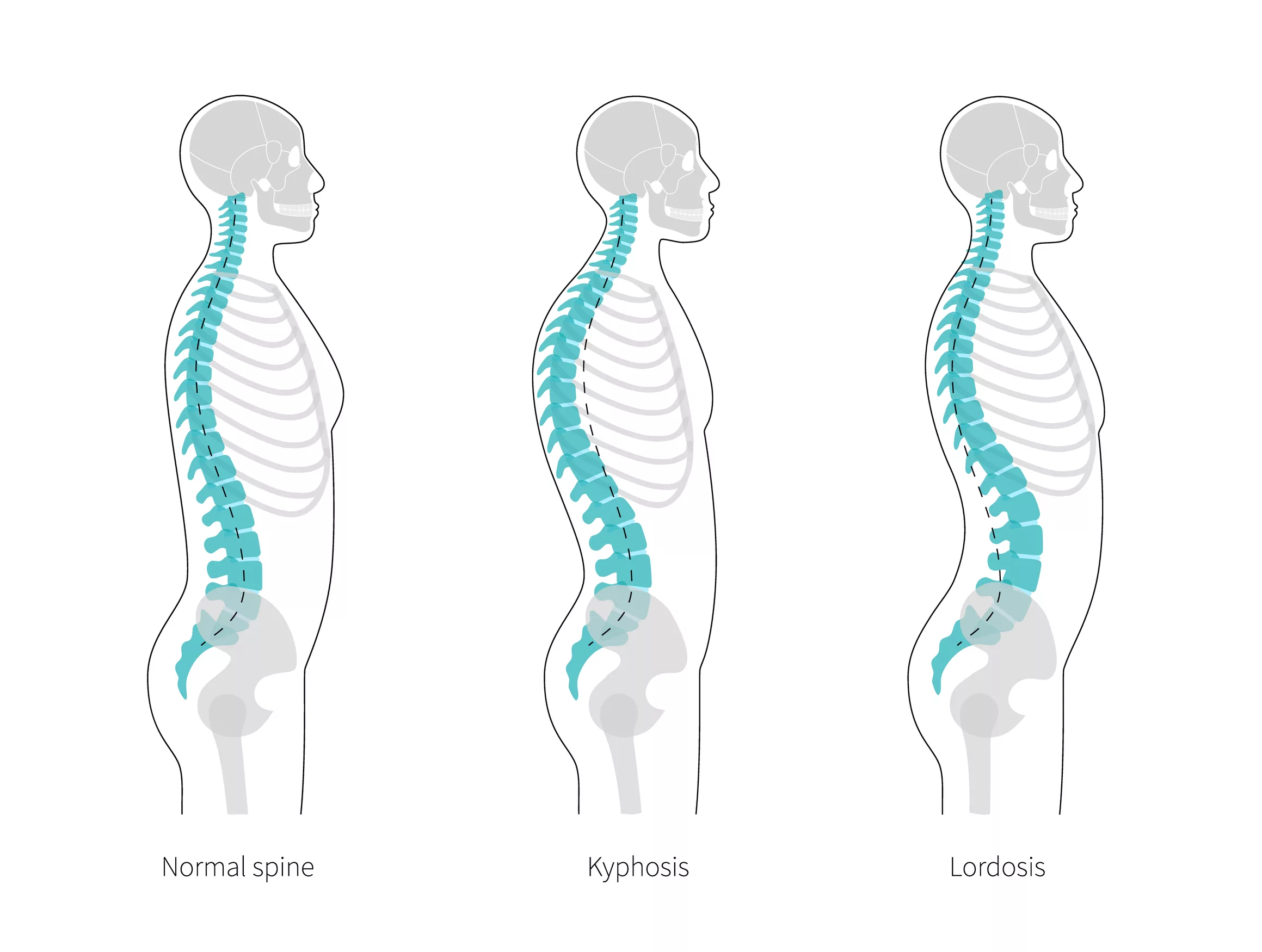 Kyphoisis, Lordosis, Normal back illustration.