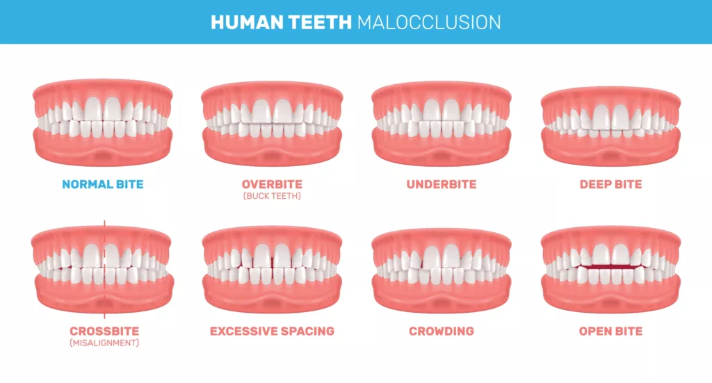 Illustration of different types of Malocclusion of teeth