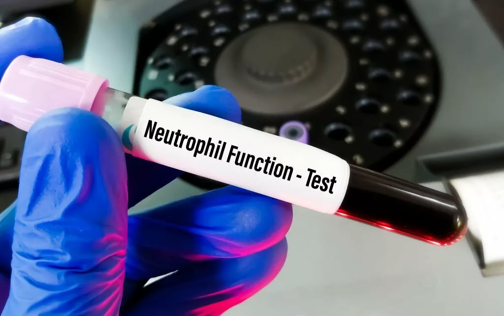 Image of Blood sample taken for Dihydrorhodamine (DHR) or Neutrophil Function Test for the diagnosis of chronic granulomatous disease (CGD).