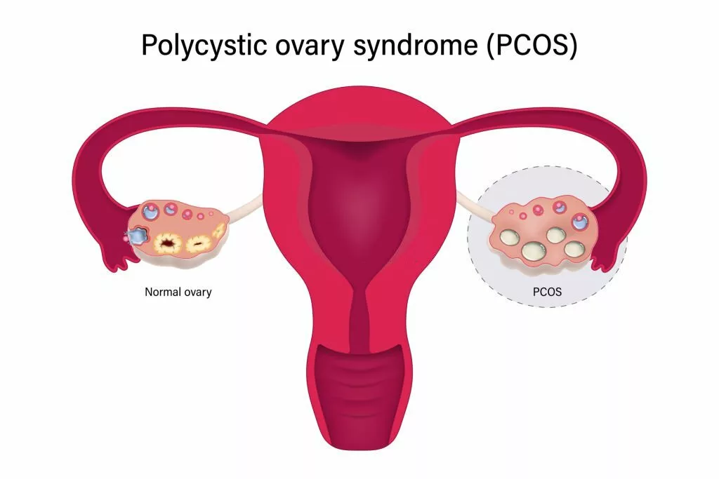 Image showing cysts in ovaries - PCOS