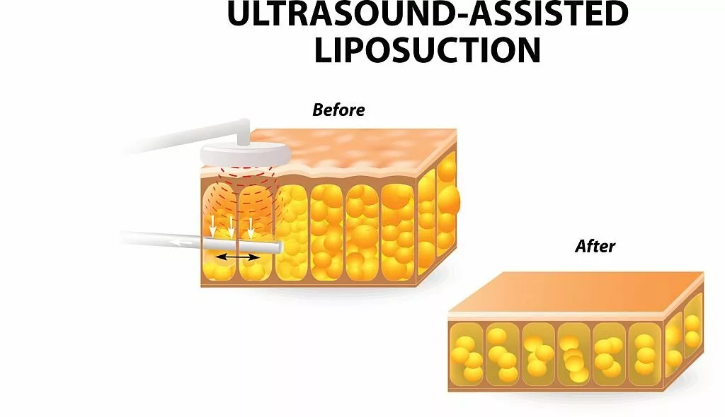 Illustration of an Ultrasound-assisted liposuction