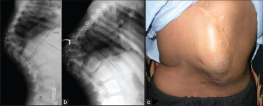 Kyphosis X-Ray