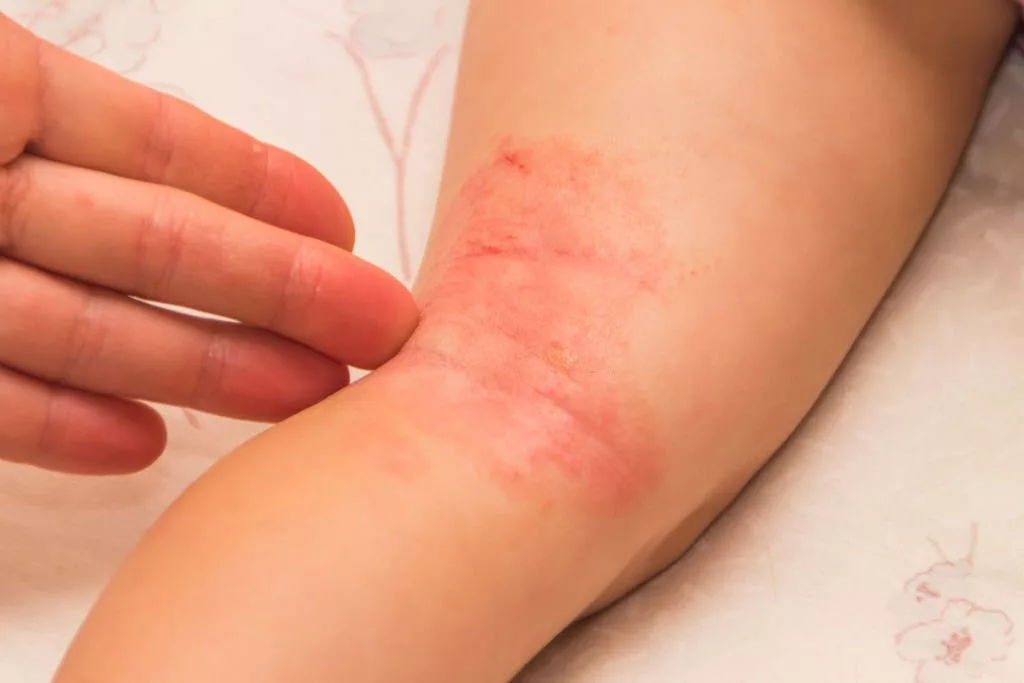 Image of a red rash caused by fungal Infection on the child's leg - Cutaneous Candidiasis