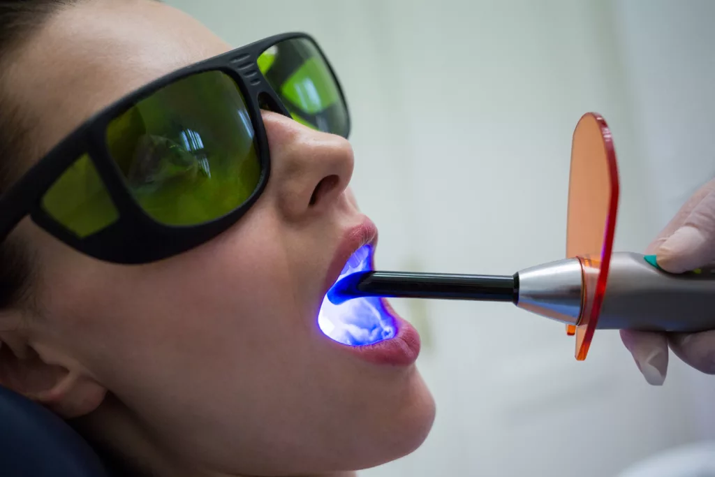 Image of a dentist curing the sealing material with the help of curing light