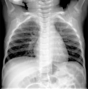 X-ray of 19-month-old child with Human metaoneumovirus