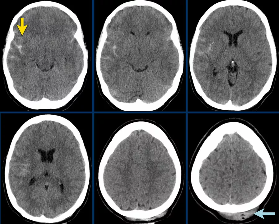 the images show hyperdense blood in the subarachnoid space of the Sylvian fissure