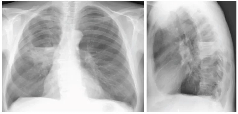 Chest X-ray showing consolidation in the right lung due to small cell carcinoma