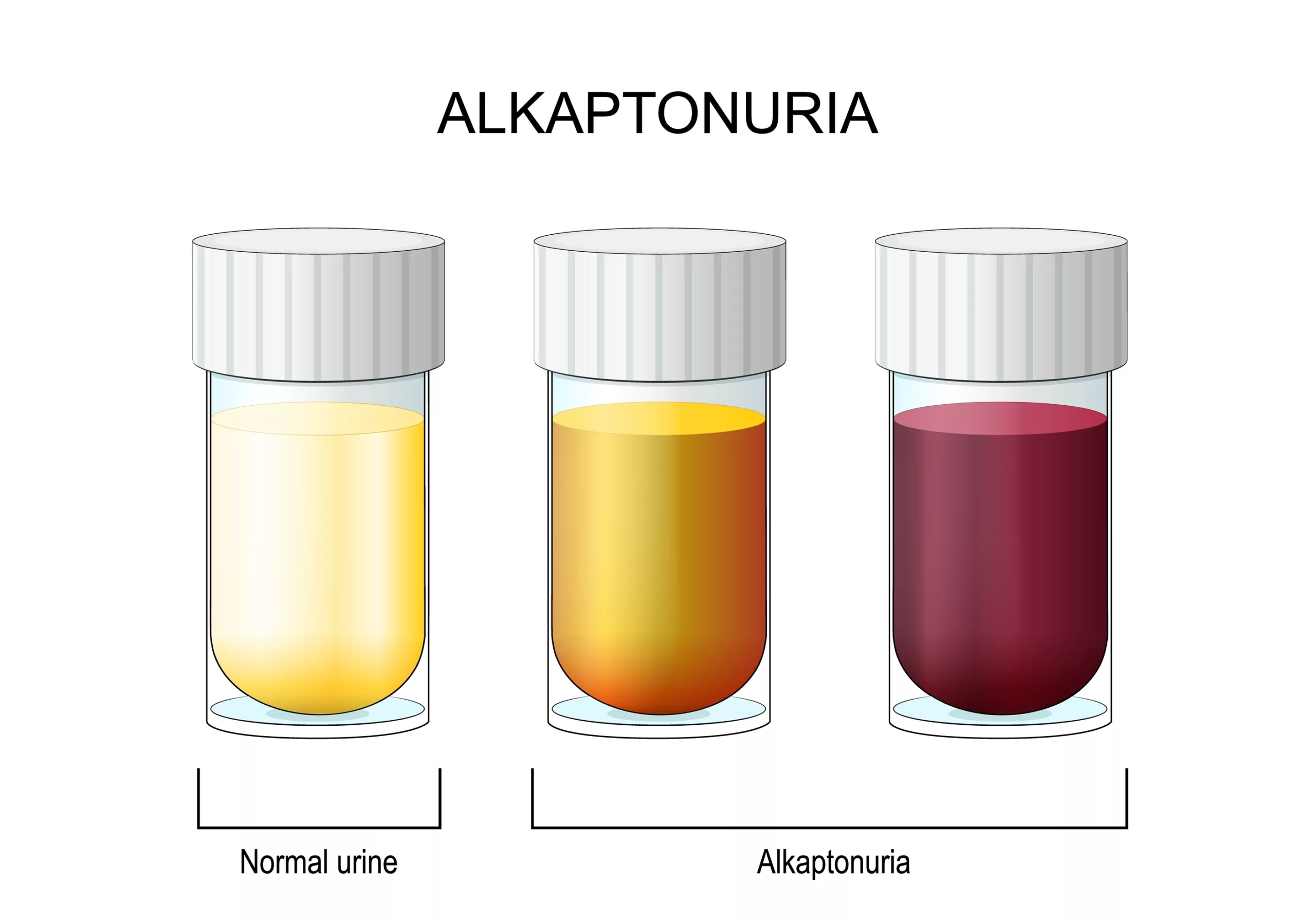 Image shows the difference between normal urine and Alkaptonuria Urine