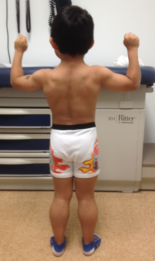 Myotonia Congenita (Beckers Disease variant) patient with hypertrophied muscles.