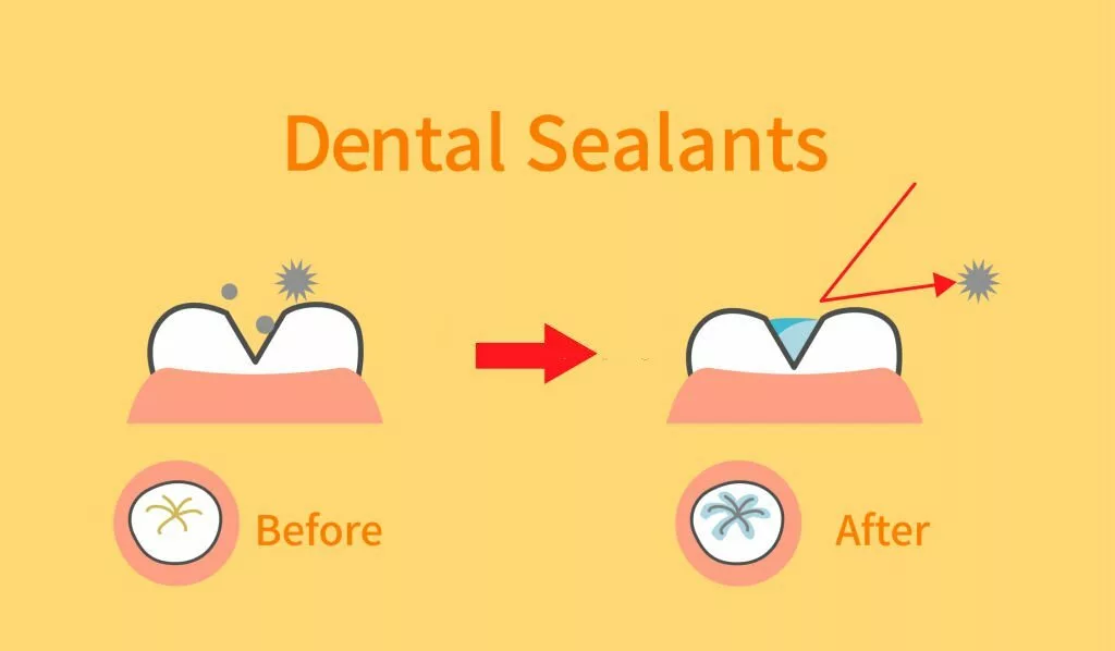Illustration of dental sealants treatment before and after