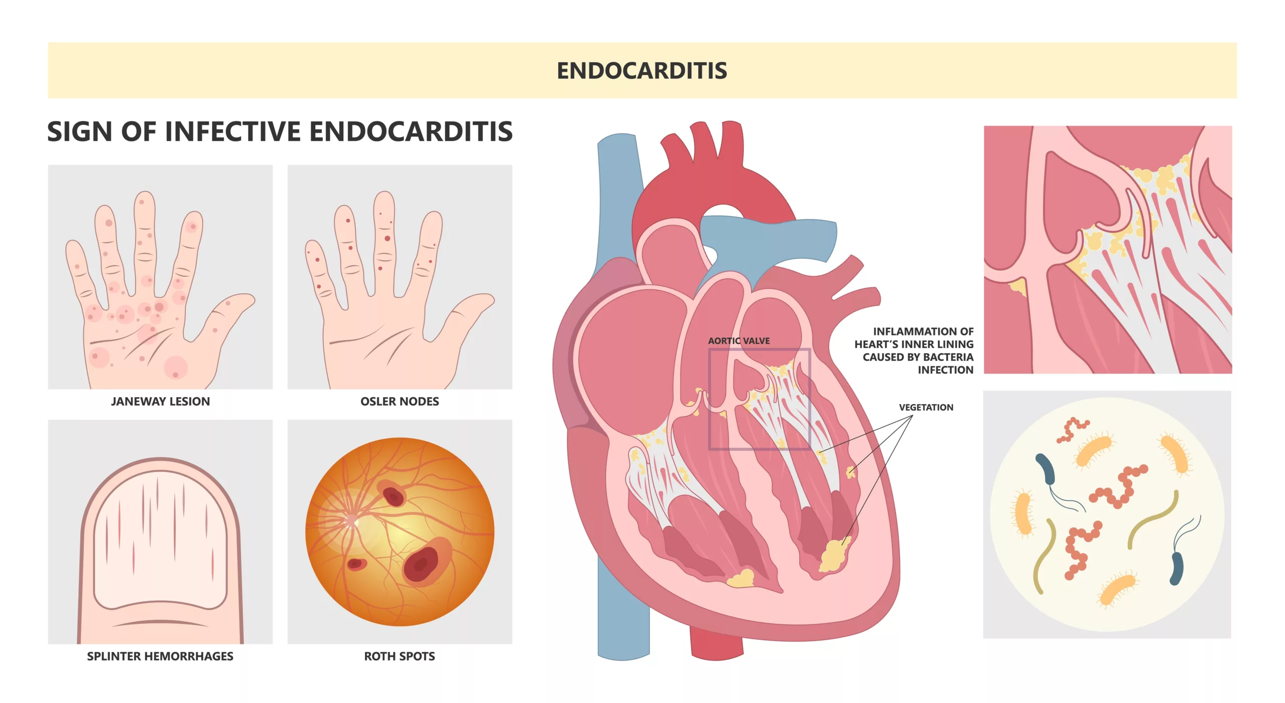 Illustration of Signs of infective endocarditis