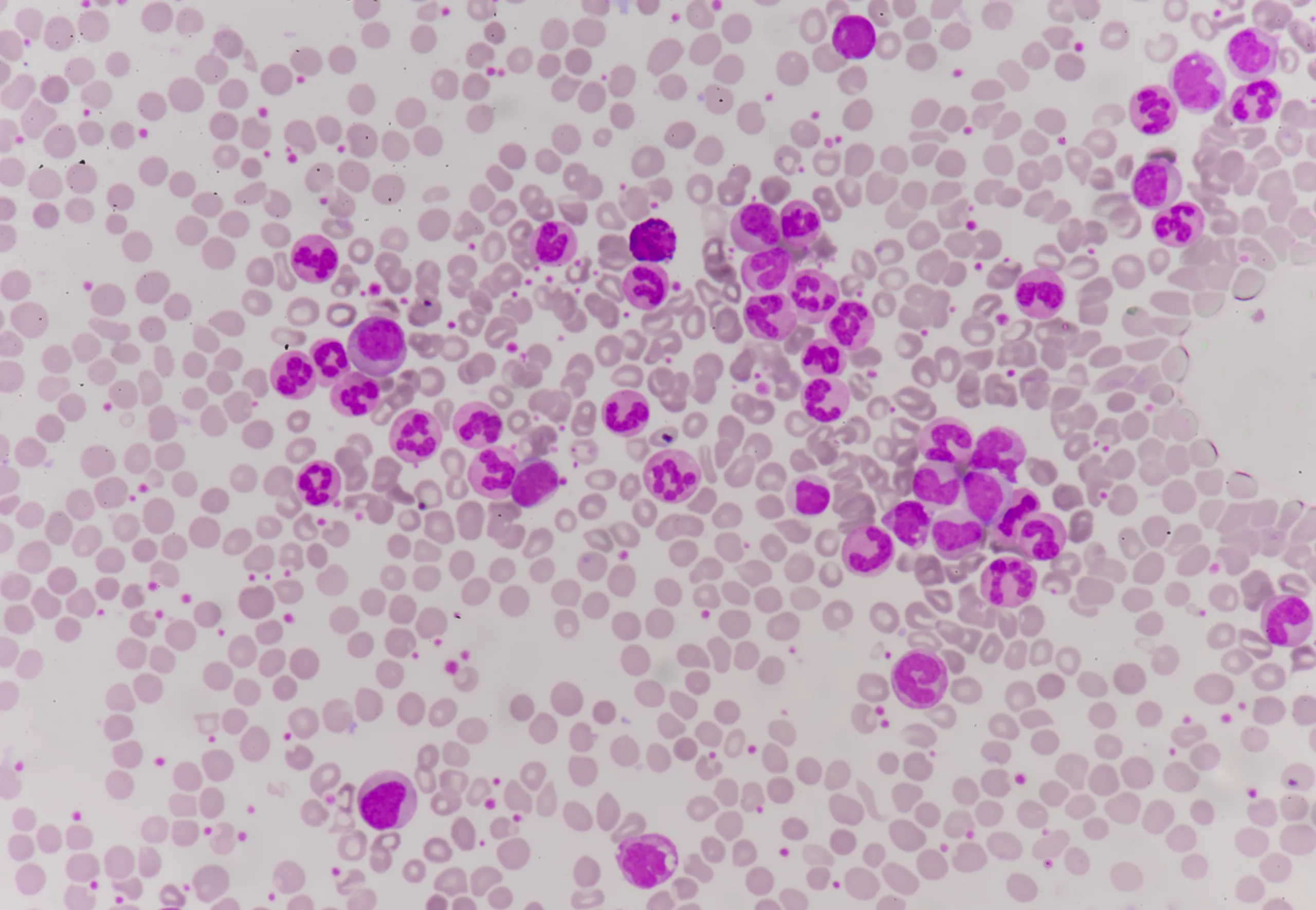 Moderate WBCs and mature neutrophils on a Red blood cell background