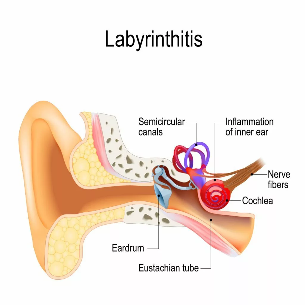  Vector illustration of Labyrinthitis for medical use