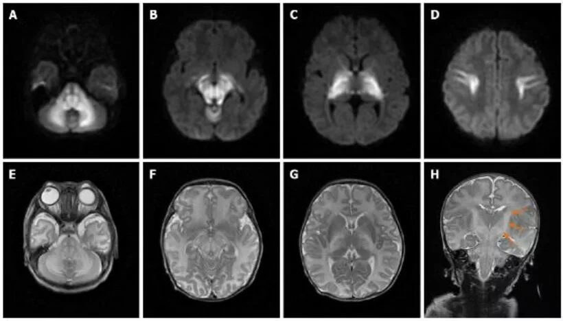  MRI of patient with Maple Syrup Urine Disease showed bilateral symmetrical lesions involving the corticospinal tracts, thalami, globus pallidus, midbrain, dorsal brain stem, and cerebellar white matter. 