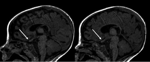 Optic nerve MRI Krabbe's disease