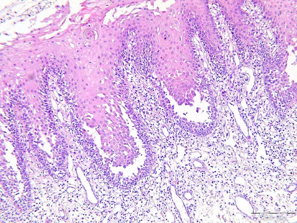 pemphigus vulgaris