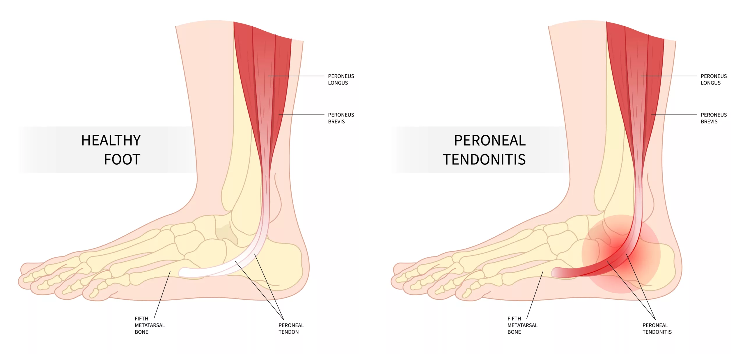 Illustration of normal foot vs. foot with peroneal tendonitis