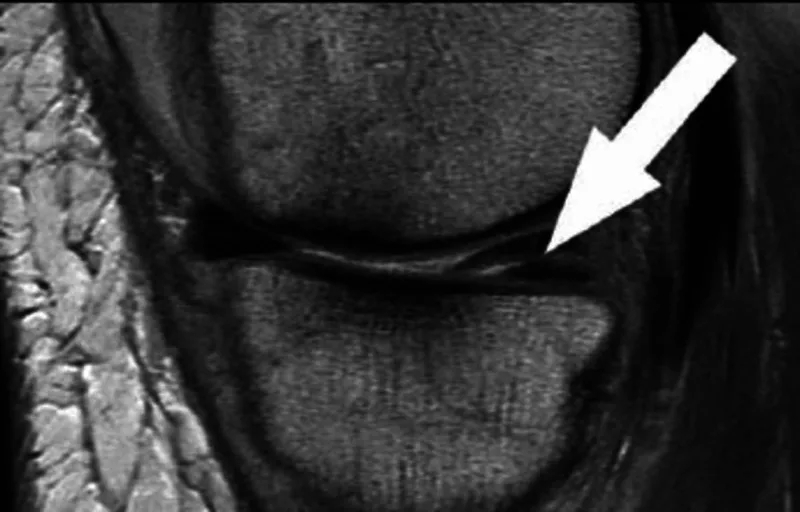 MRI showing a horizontal tear in the posterior horn of medial meniscus