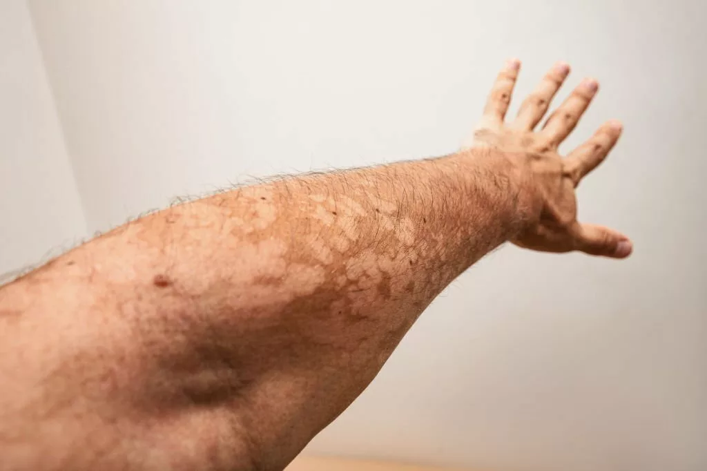 Image of A man's hand with a fungal dermatological skin disease. Symptoms of severe scratching and exfoliation of the epidermis