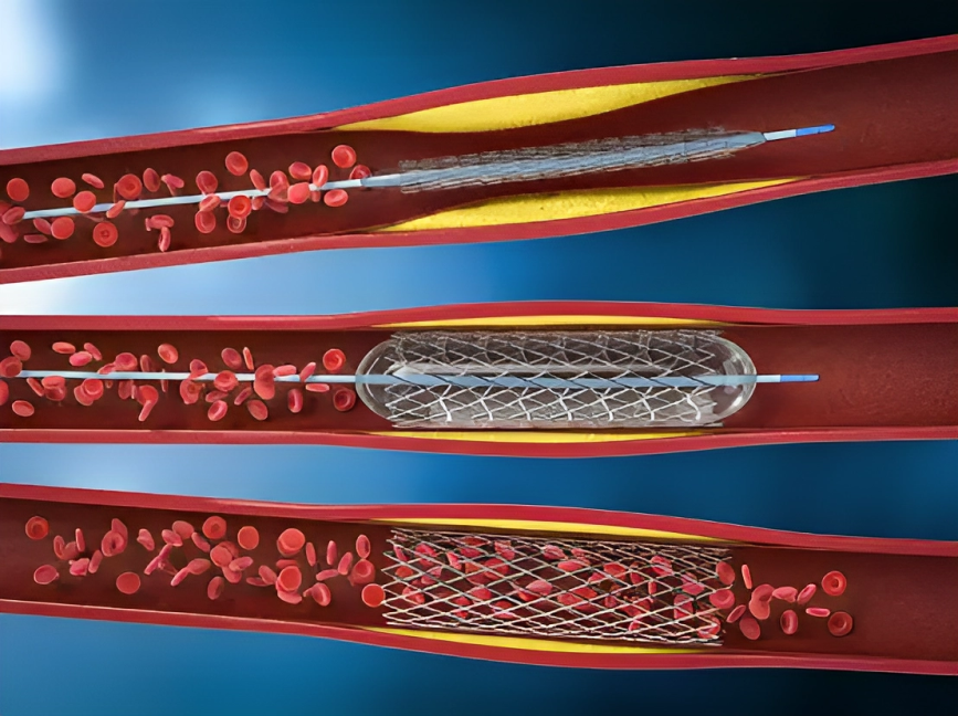 Angioplasty for Renal Artery Stenosis