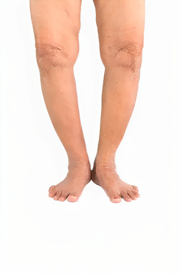 Image of Bowed Legs