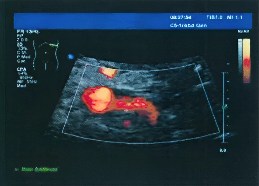 Infra-renal Doppler Waveform for the diagnosis of RAS