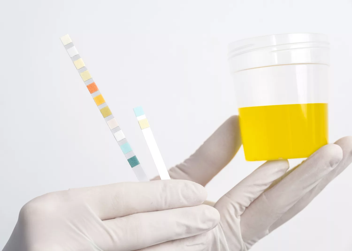 Glycosuria can be tested for by using urinalysis