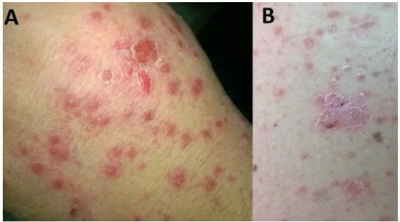 Small, red, drop-like lesions of Guttate psoriasis located at the hand (A) and the arm (B) of the patient