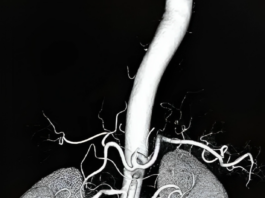 Renal Artery