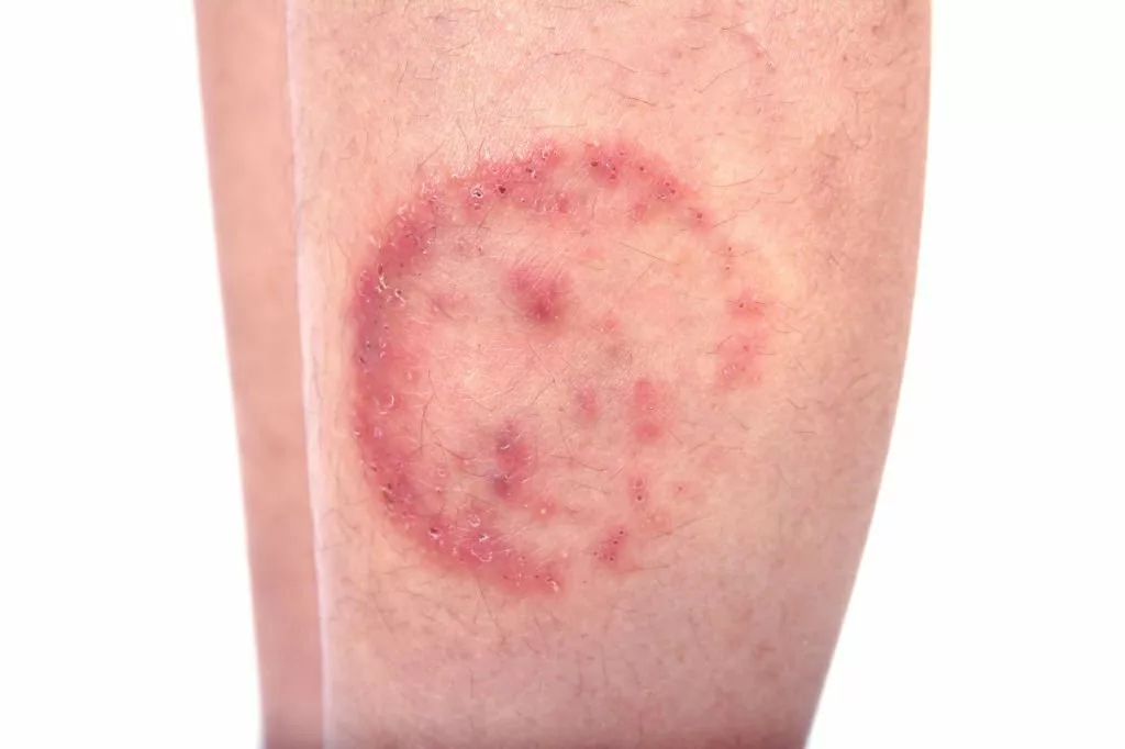 Closeup of ringworm infection or Tinea corporis on skin isolated on a white background.