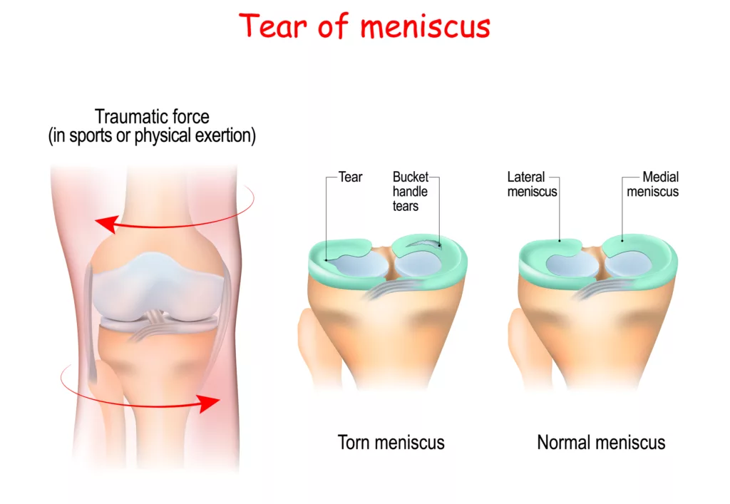 The image shows normal vs. torn meniscus