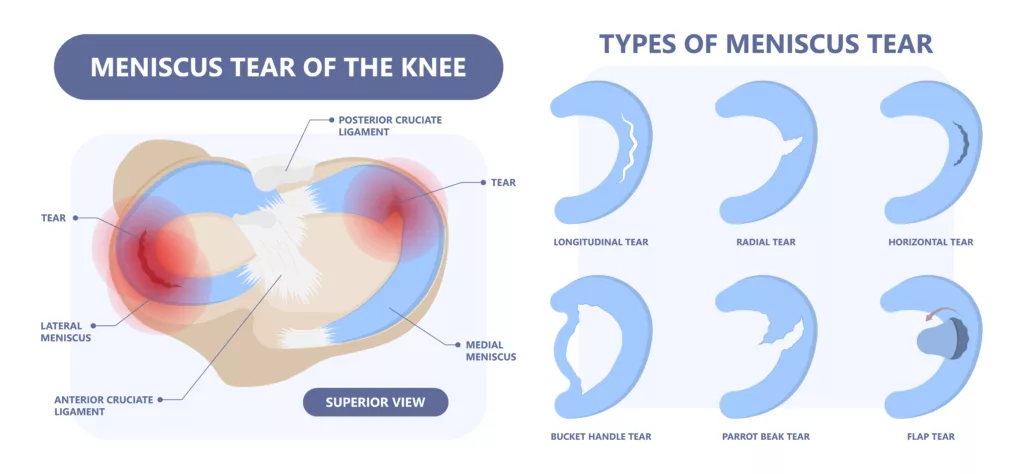 The image illustrates various types of meniscal tears