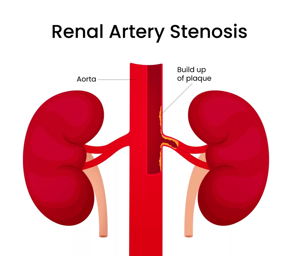 Image shows stenosis of renal artery