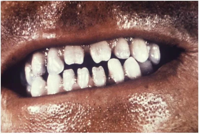 Congenital syphilis-Huthcinson Teeth