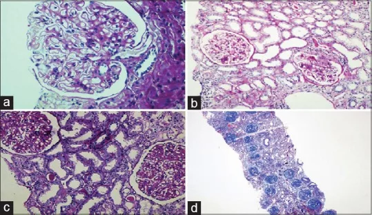 Histological picture of different stages of lupus nephritis