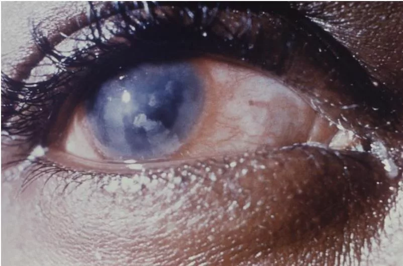 corneal keratitis, due to a congenital syphilis