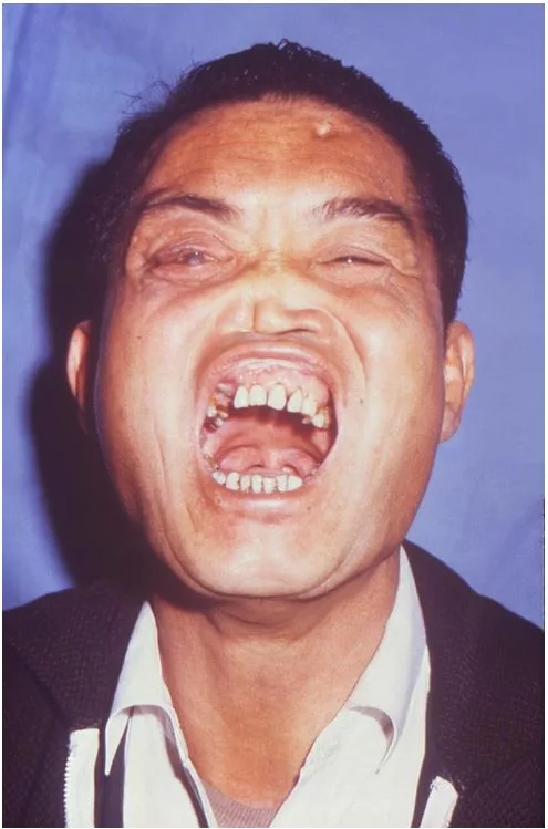 Congenital Syphilis: Frontal bossing, mulberry molars, Hutchinson teeth, saddle nose