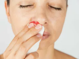 Image of a lady with a nosebleed