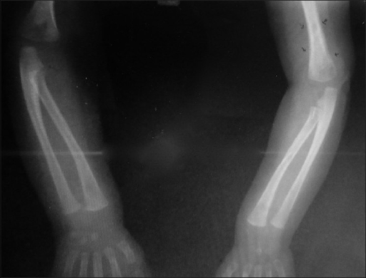 Congenital Syphilis-Periosteak reaction