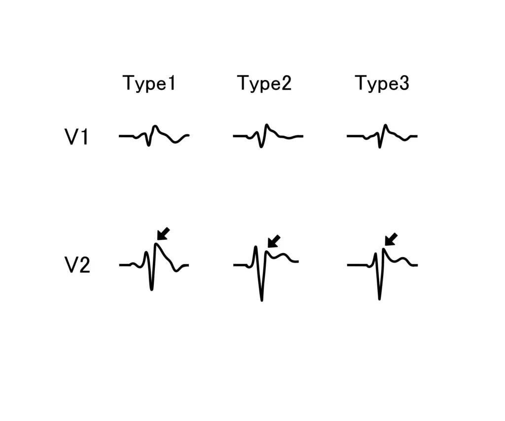 ECG pattern of all 3 Types of Brugada Syndrome