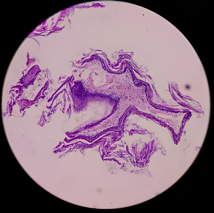 Microscopic examination of Cholesteatoma