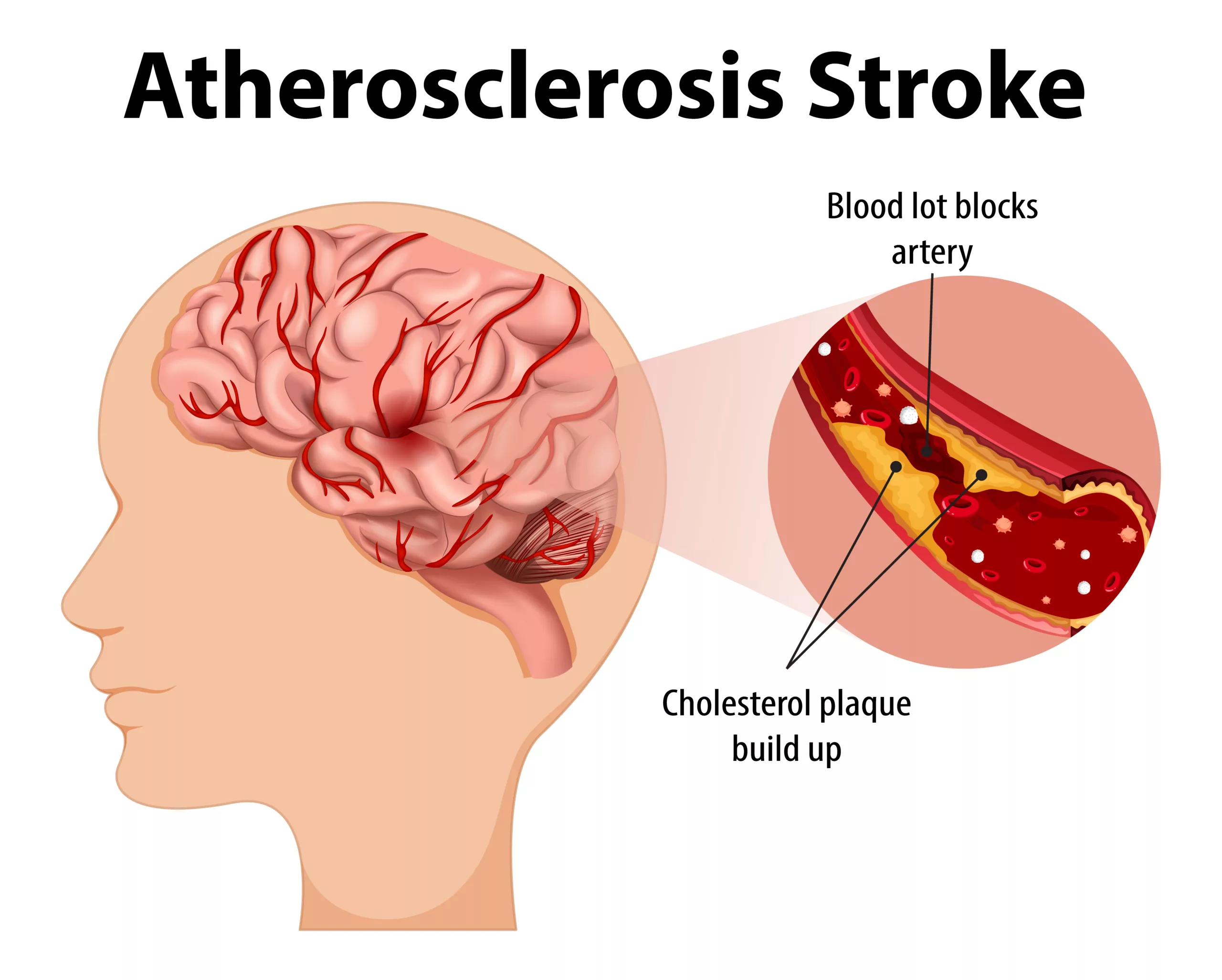 illustration of Human anatomy with atherosclerosis stroke 