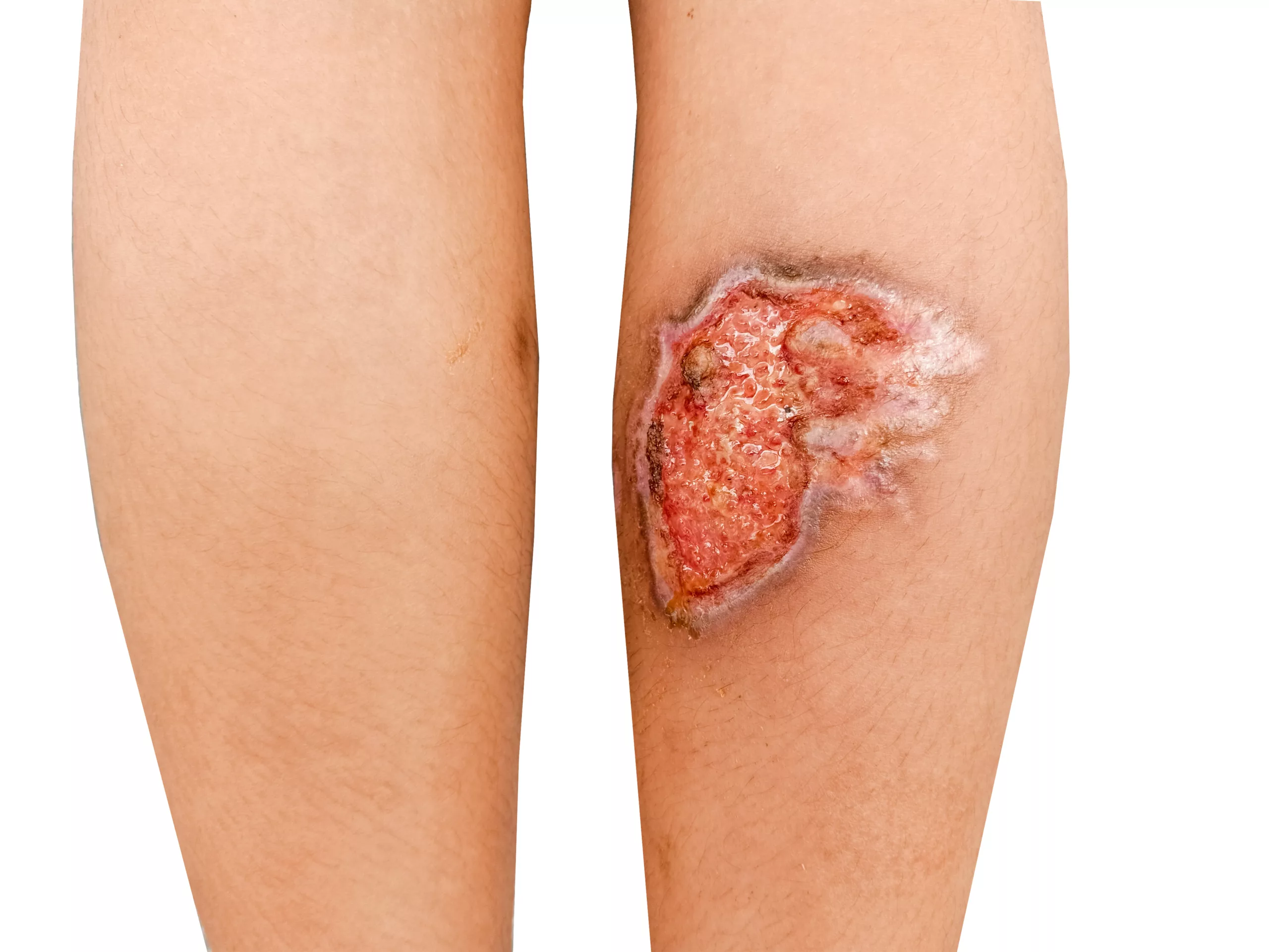 The image shows a leg ulcer as a complication in Stasis Dermatitis