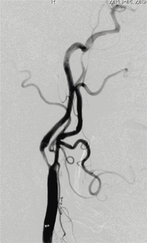 Arteriography of the left common carotid artery. High-grade stenosis in the proximal part of the internal carotid artery