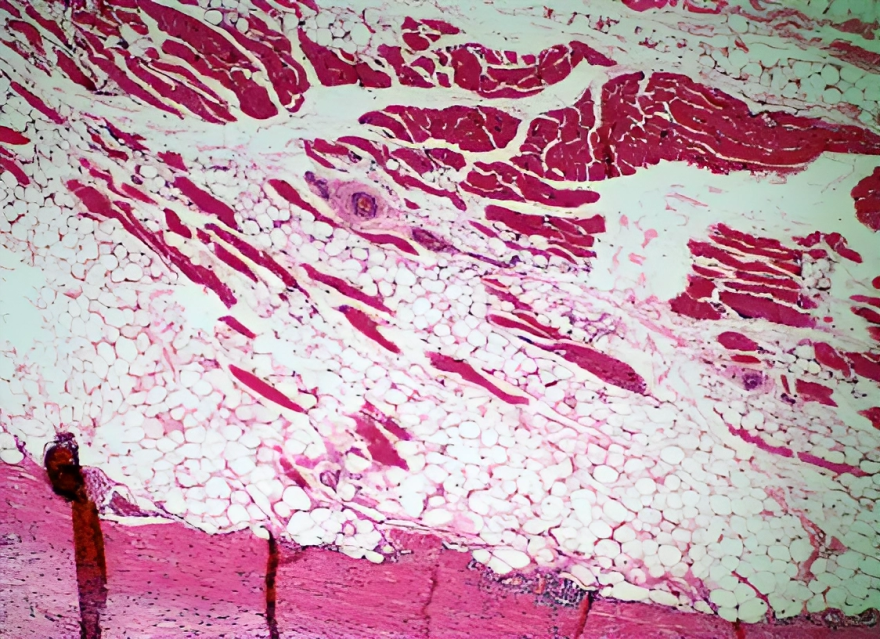 Histopathology of adenoid cystic carcinoma of salivary glands showing cyst-like spaces with basaloid cells