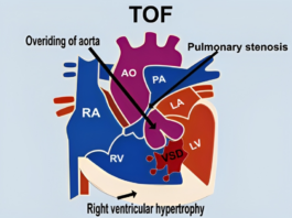 Cardinal features of TOF