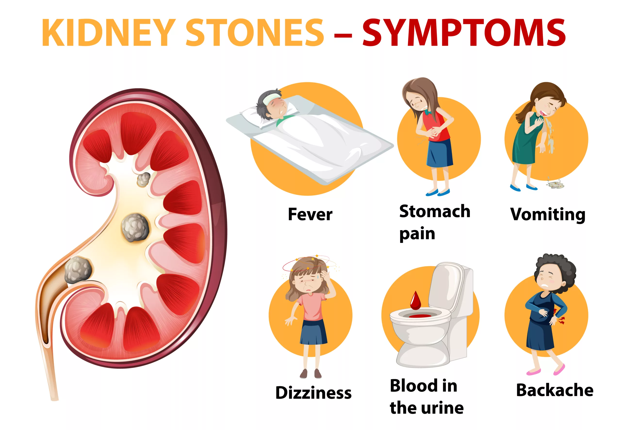 Pictorial Representation of Kidney Stones