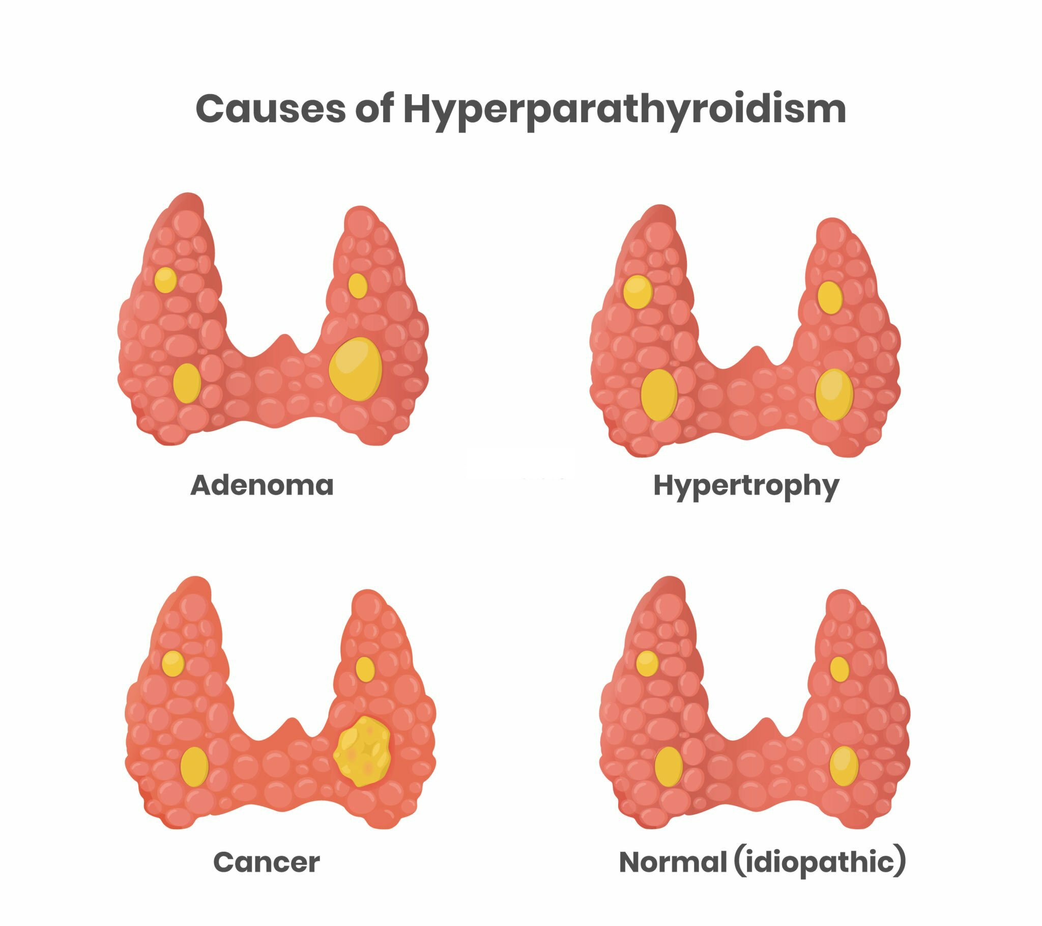 Image shows different causes of Hyperparathyroidism