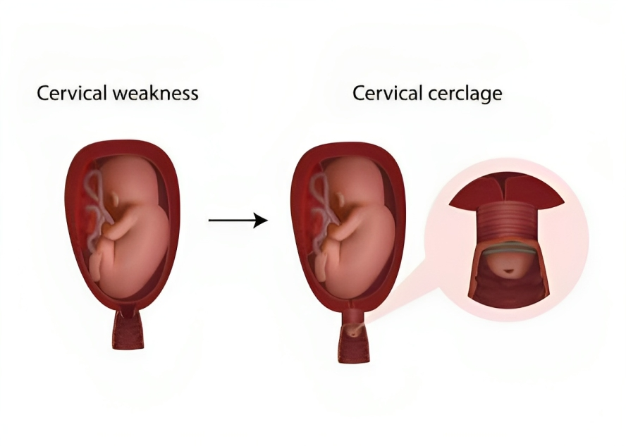 Cervical Cerclage in case of Weakened Cervix