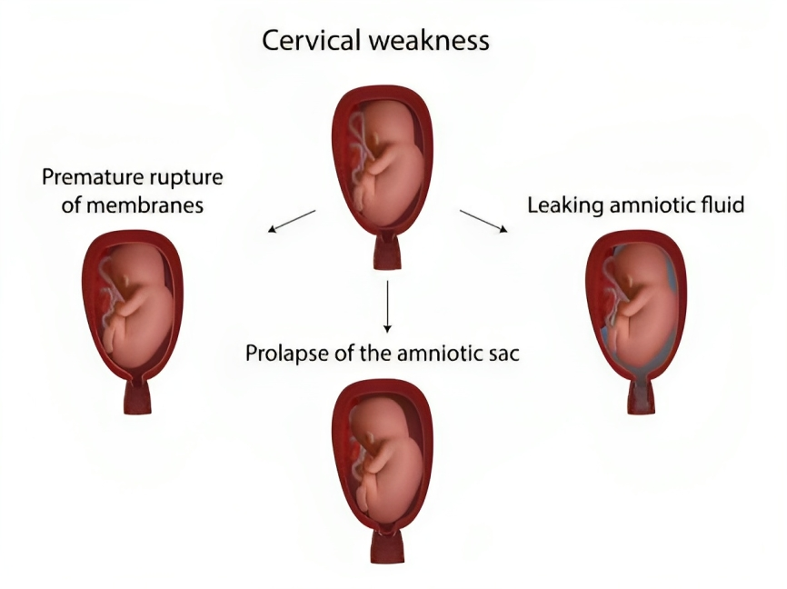 Image shows the Cervical insufficiency's signs and symptoms